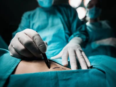 Brustvergrößerung mit Eigenfett: Wie funktioniert der Eingriff und was sind die Vorteile?